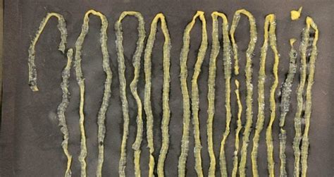 Doctors Extract 9 Foot Tapeworm From Singaporean Mans Rectum