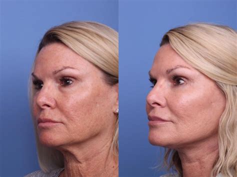 Facelift Before And After Pictures Case 399 Scottsdale Az Hobgood Facial Plastic Surgery