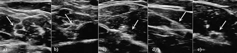 Sonographic Images Of The Peripheral Nerves Of The Upper Extremity And