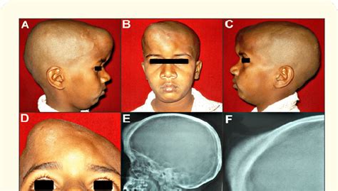A B C D A 11 Year Old Male Patient With A Large Dome Shaped Bony