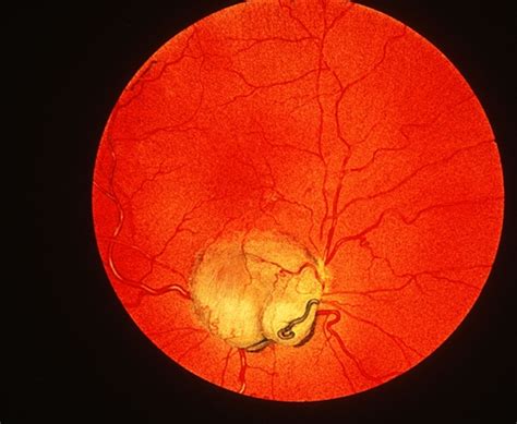 Coloboma Of The Optic Nerve Possible A Copy Of A Drawing Retina