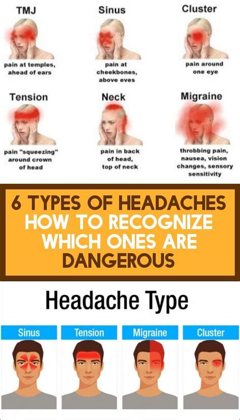 Types Of Headaches How To Recognize Which Of Them Are Dangerous