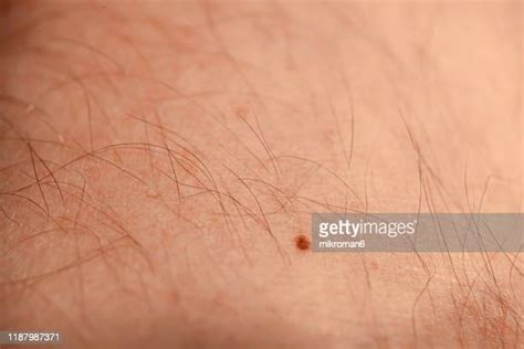 Red Mark On Skin Photos And Premium High Res Pictures Getty Images