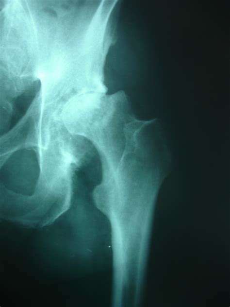 Preoperative Anteroposterior Radiograph Of The Left Hip Avascular