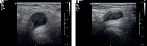 Femoral Vs Inguinal Hernia Ultrasound