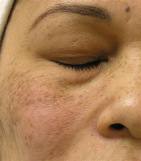 Weitere ideen zu frau frau pärchen vorher nachher. Hydra Facial - medical-wellness-deege.de