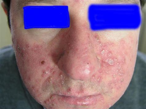 Diseases Of The Sebaceous Glands Acne Cystic Picture Hellenic