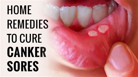 How To Get Rid Of Canker Sores Fast Naturally Just In 2 Minutes Youtube