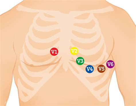 The 12 Lead Ecg Is A Standard Diagnostic Tool For Emts And