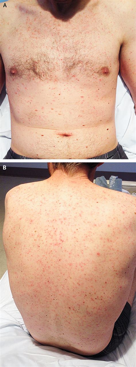 Case Challenge — A Man With Fevers Rash Pancytopenia And Abnormal