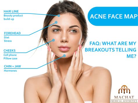Acne Face Map Reading The Signs Machat Medical Clinic