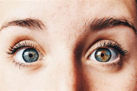 Two Colors Are Always Better Than One Heterochromia Agrees By Optometry Daily Medium