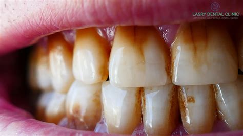 How To Get Rid Of Teeth Discoloration At Home And Professional Options