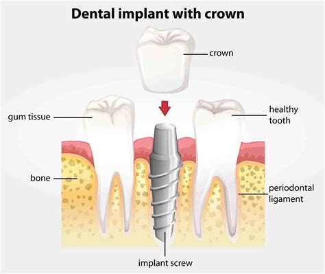 How Does A Dental Implant Work Dental News Network