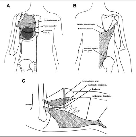 Figure From Latissimus Dorsi Flap In Breast Reconstruction Semantic