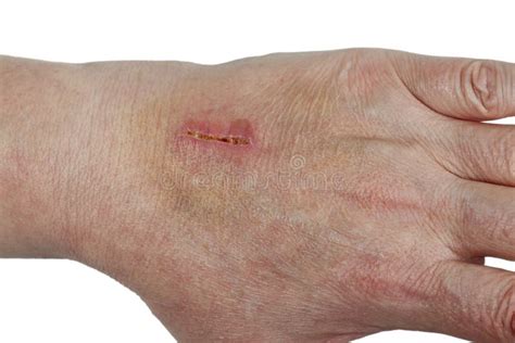 Laceration Stock Photo Image Of Laceration Palm Wound 404188