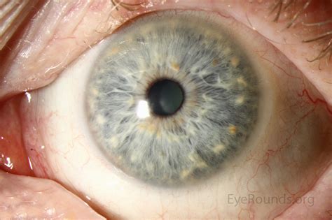 Due to the high prevalence of problems (e.g., myopia, hyperopia, cataracts, strabismus. Kunkmann-Wolffian bodies