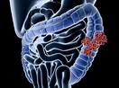 Colon Cancer: Overview and More