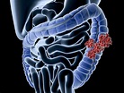 Colon Cancer: Causes and Risk Factors