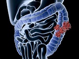 Colon Cancer: Overview and More