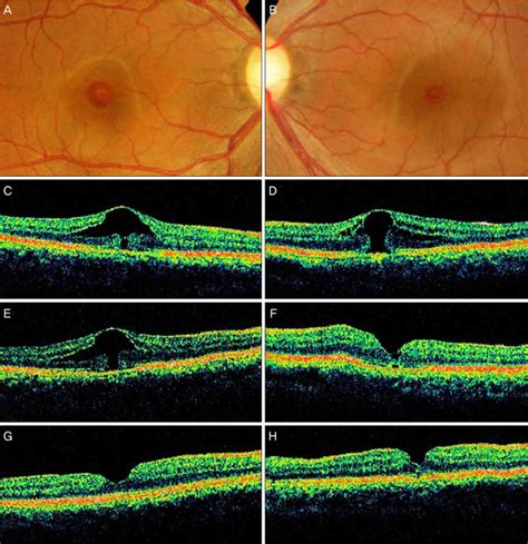 Macular Hole Causes Symptoms Diagnosis Treatment And Prognosis