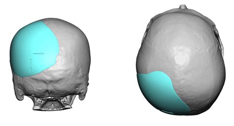Plastic Surgery Case Study Custom Skull Implant For Male Occipital