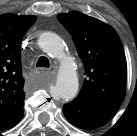 Multidetector Ct Of Thoracic Aortic Aneurysms Radiographics