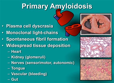 Pin On Cancer Amyloidosis And Multiple Myeloma