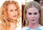 Nicole Kidman Before and after plastic surgery – Celebrity plastic ...