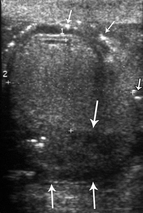 Us Of Acute Scrotal Trauma Optimal Technique Imaging Findings And