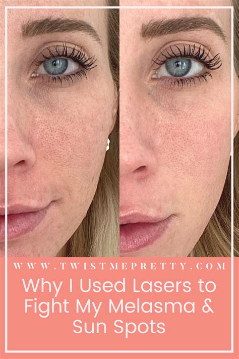 Treating Melasma With The Light And Bright Laser Twist Me Pretty