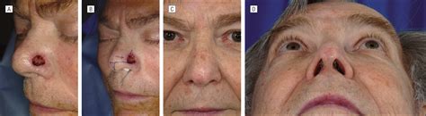 Reconstruction Of Nasal Defects 15 Cm Or Smaller Jama Facial Plastic
