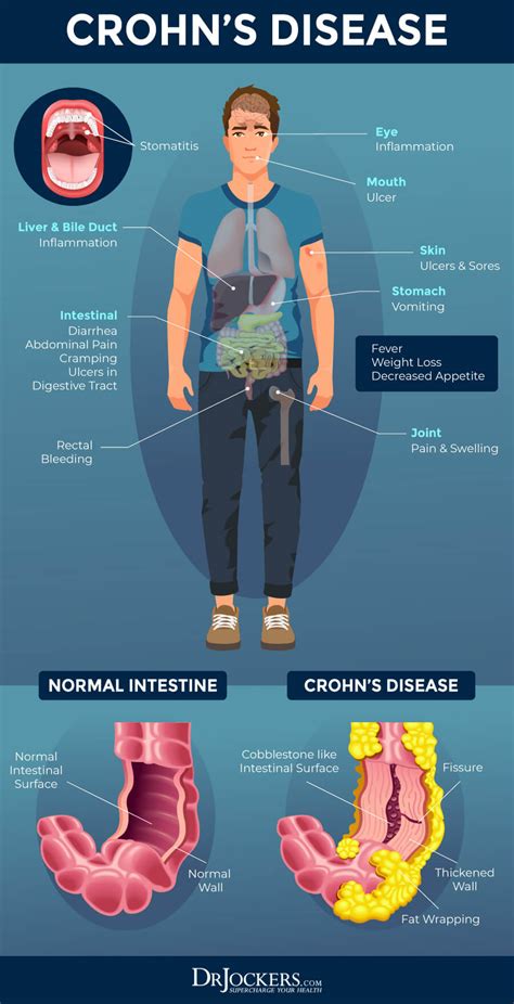Crohn’s Disease Symptoms Causes And Natural Support Strategies