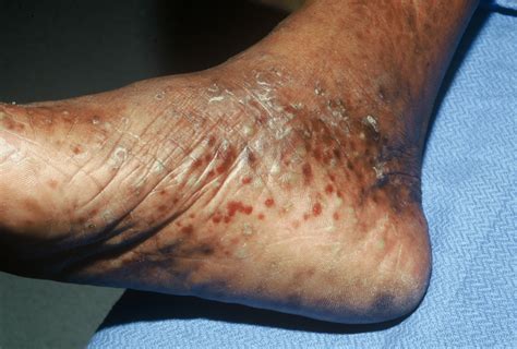 Dyshidrotic Eczema On Feet