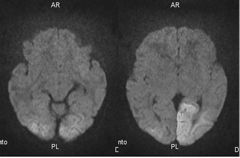 Diffusion Weighted Magnetic Resonance Imaging Of The Brain Performed On