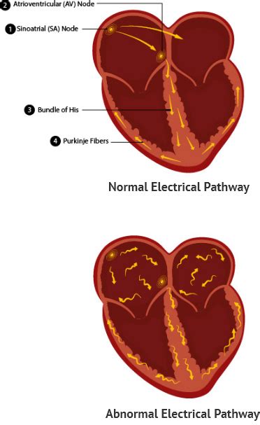 Arrhythmias Elite Cardiovascular Group