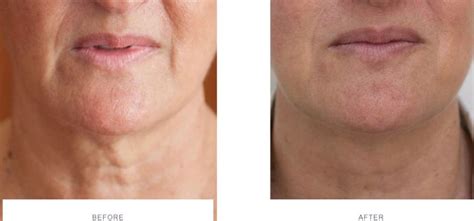 Neck Lift Using Botox Thread Lift Ultherapy Non Surgical Neck Lift
