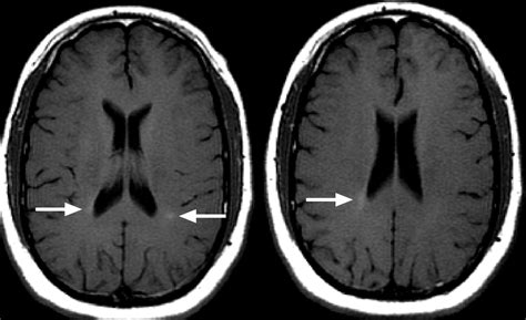 Multiple Sclerosis Research Problems With Assessing New Lesions On Mri