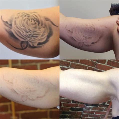 Vol 1 Top 10 Before And After Tattoo Removal Results Removery