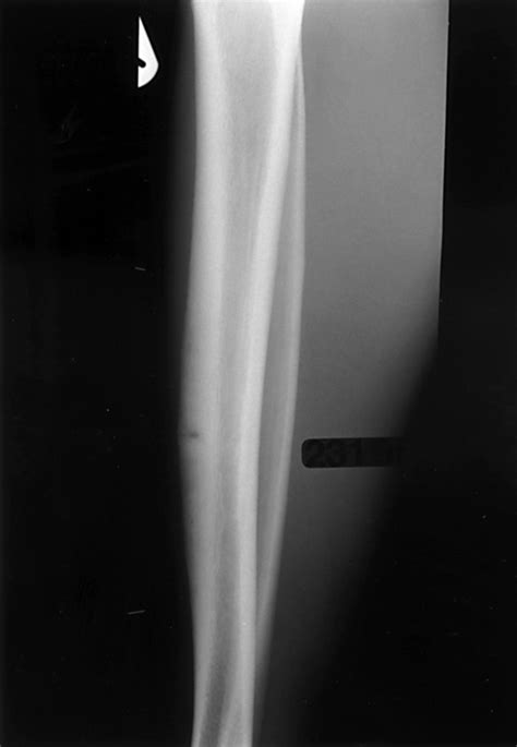 Delayed Union Stress Fractures Of The Anterior Tibia Conservative