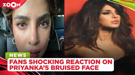 Priyanka Chopra Shares A Bruised Look Face Fans Are Shocked
