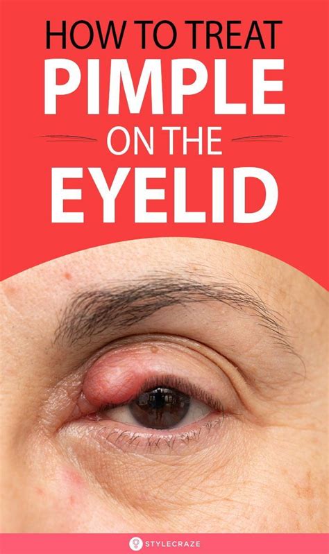 Home Remedies To Treat Pimple On The Eyelid Pimple On Eyelid How To