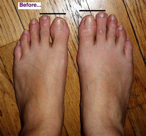 You may be able to fix your toe with home treatment. How To Fix Hammer Toes Without Surgery - lottelette's blog