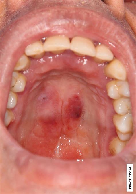 Oral Mucosal Lesion An Erythematous Plaque On The Palate Near The