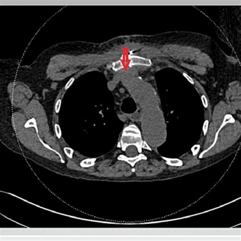 Non Contrast Chest Ct Performed Two Months Later Showing The Left