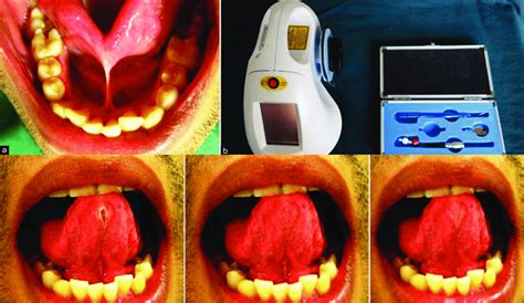 Lingual Frenectomy Using Diode Laser A Preoperative View Showing Download Scientific Diagram