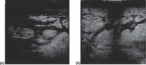 Mastitis On Ultrasound