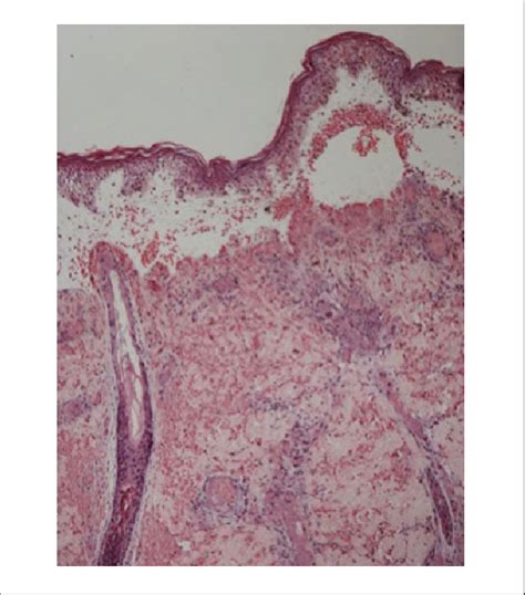 Histopathological Examination Of The Border Of The Necrotic Lesion At