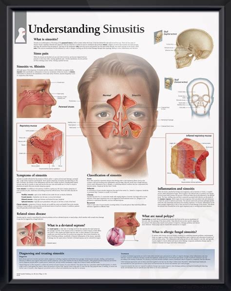 Understanding Sinusitis Chart 22x28 Sinusitis Sinus Infection Back