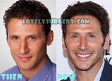 Mark Feuerstein Plastic Surgery Before and After Photos - Lovely Surgery